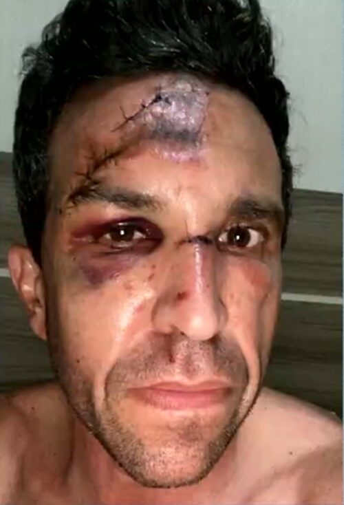 Após cair em buraco coberto por água em Palmas, ciclista tem o rosto desfigurado